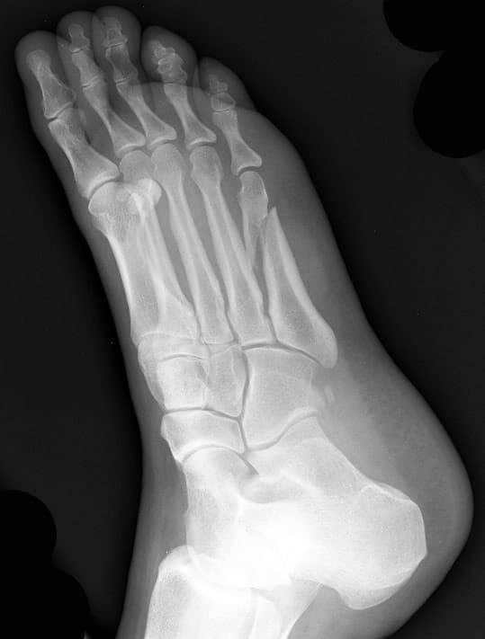 spiralfracture5thmetatarsal